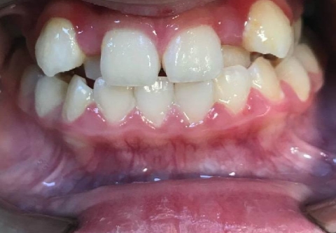 Niềng răng khấp khểnh mất bao lâu? Bao nhiêu tiền?